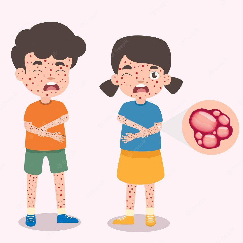 ilustrasi cacar air (freepik.com)