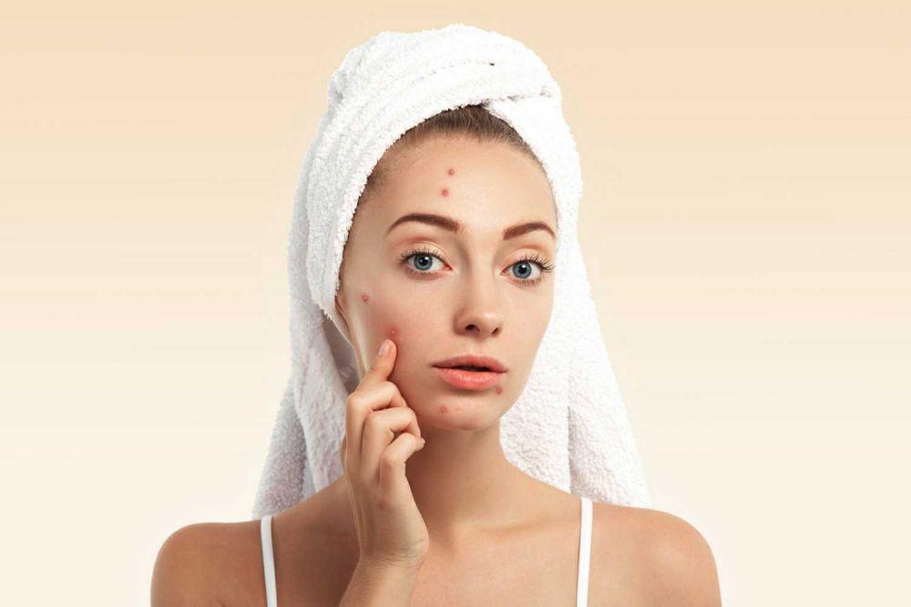 5 Rekomendasi Acne Lotion, Ampuh Mengempiskan Jerawat