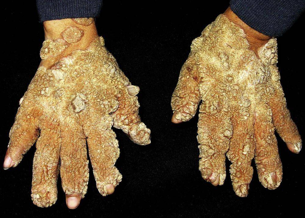 Epidermodysplasia verruciformis, tree man syndrome, atau penyakit manusia pohon dalam kondisi parah. (mayoclinicproceedings.org/Wei Liu, MD Dong-Lai Ma, MD, PhD)
