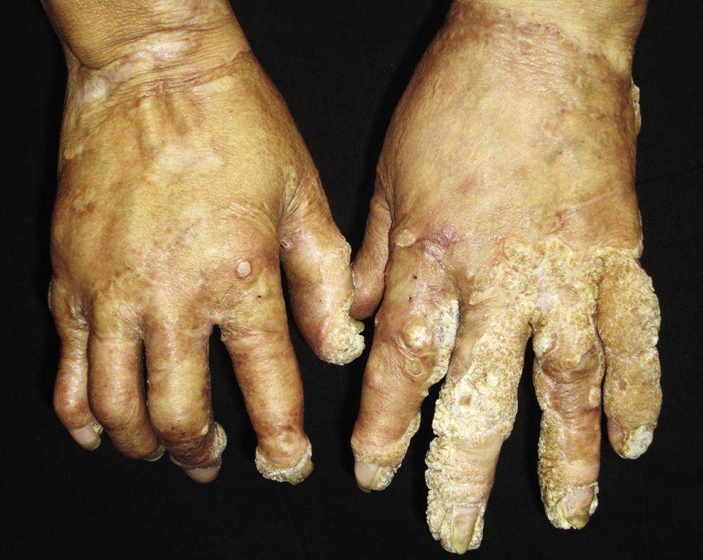 Epidermodysplasia verruciformis, tree man syndrome, atau penyakit manusia pohon. (mayoclinicproceedings.org/Wei Liu, MD Dong-Lai Ma, MD, PhD)
