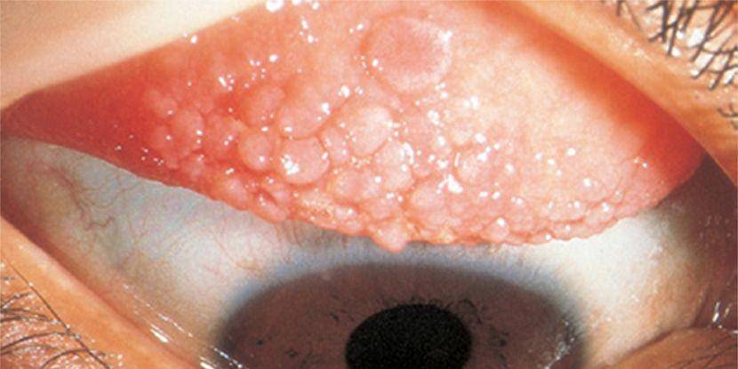 ilustrasi konjungtivitis papiler raksasa atau giant papillary conjunctivitis (aao.org)