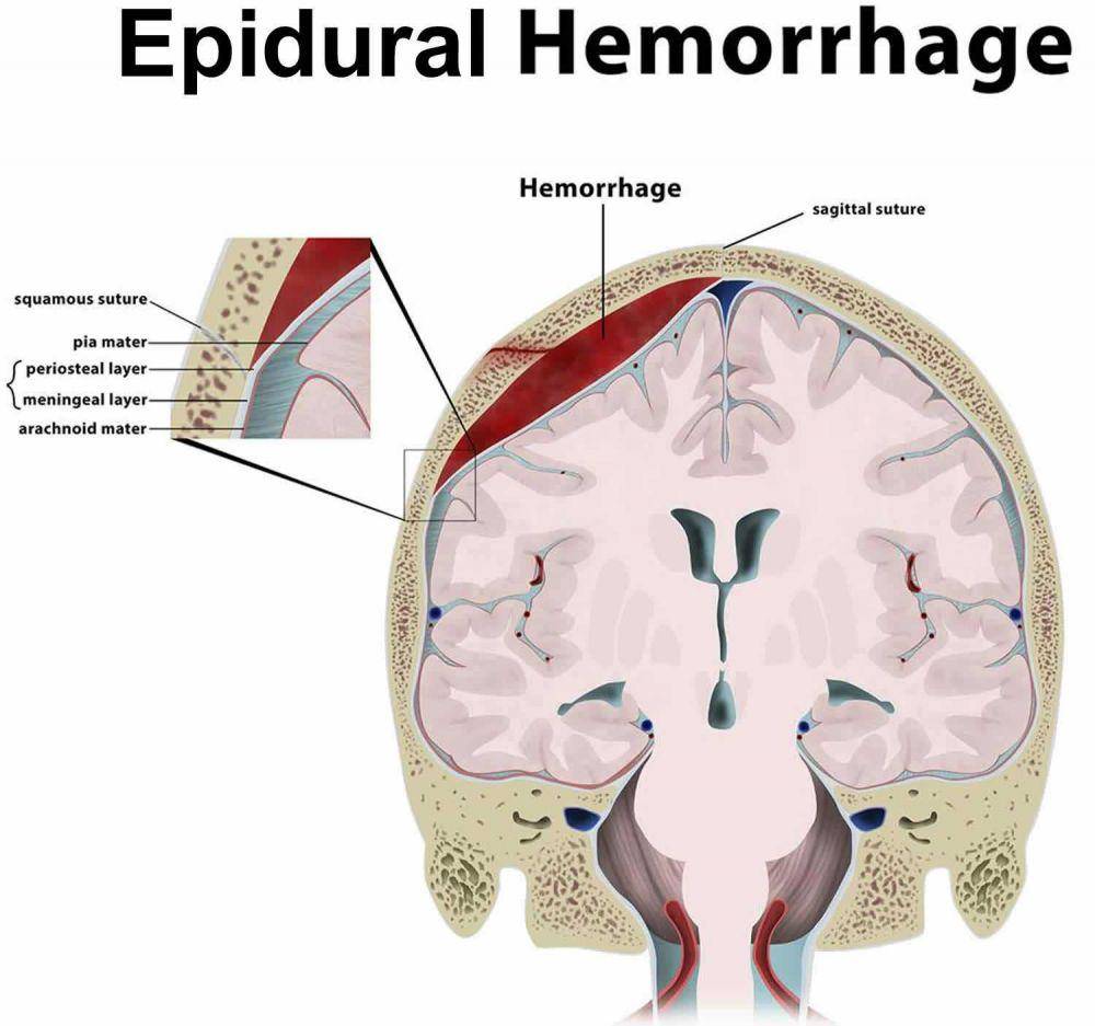 ilustrasi hematoma epidural (healthjade.com)