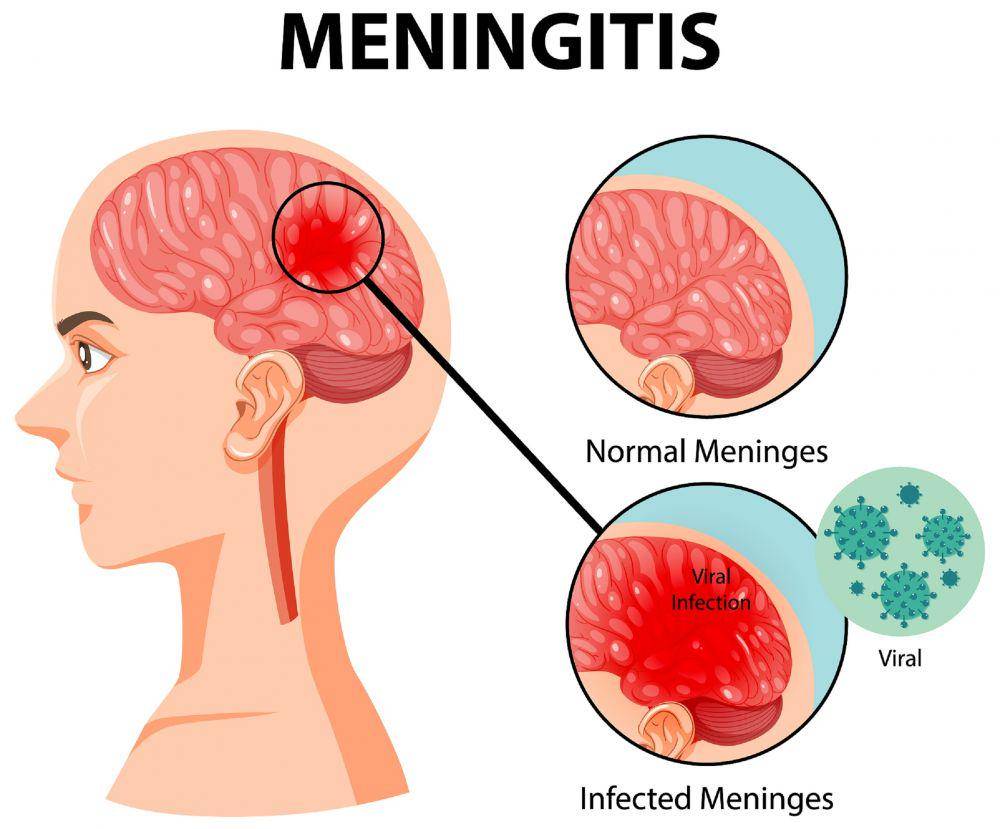ilustrasi penyakit meningitis (freepik.com/brgfx)