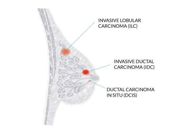 ilustrasi karsinoma lobular invasif (mybreastcancertreatment.org)