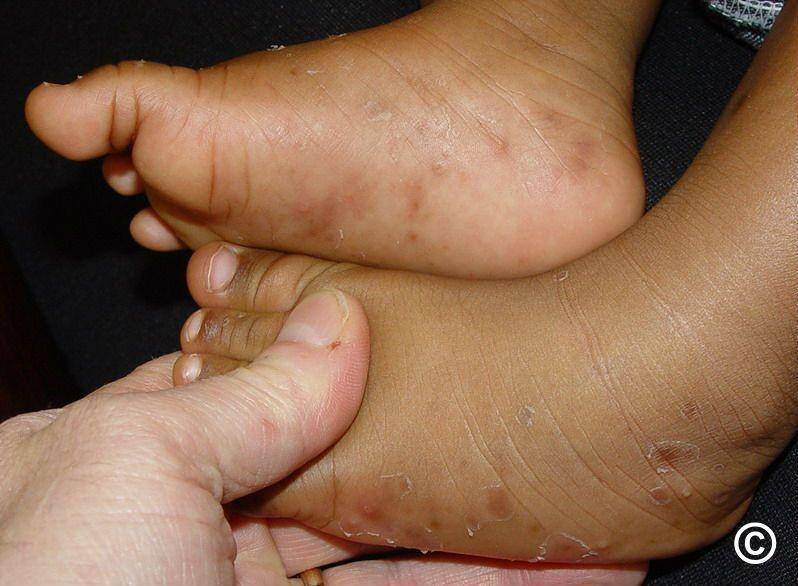 ilustrasi akropustulosis pada bayi (pcds.org.uk)