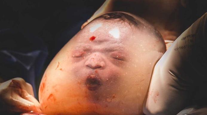 Fakta Kelahiran En Caul, Bayi Lahir Terbungkus Kantung Ketuban