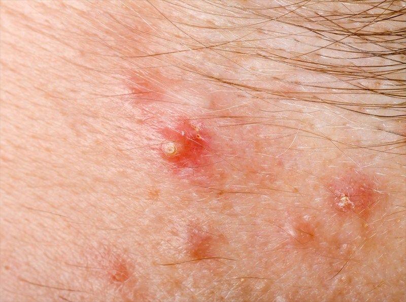 Folikulitis: Penyebab, Gejala, Pengobatan, Pencegahan