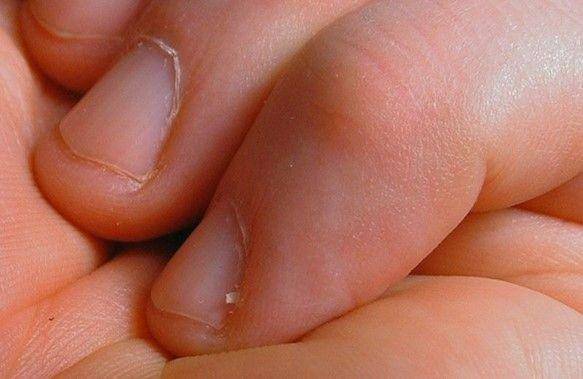 ilustrasi hangnail (wikimedia.org)