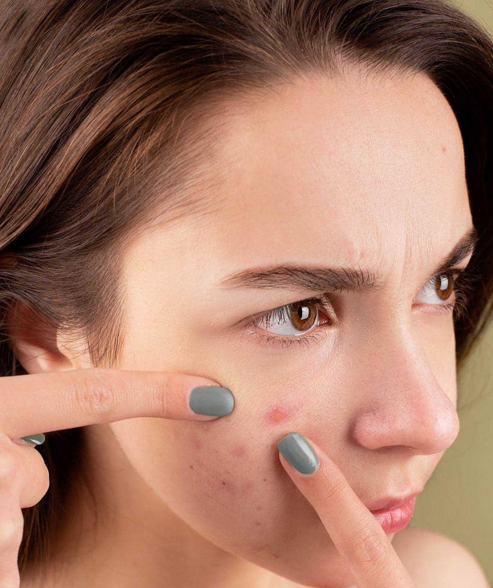 ilustrasi jerawat (pexels.com/Anna Nekrashevich)