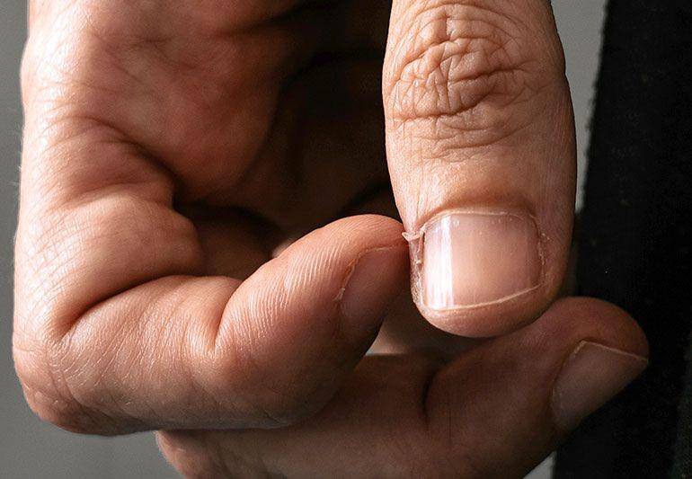 ilustrasi hangnail atau sobekan kulit di kuku (health.clevelandclinic.org)