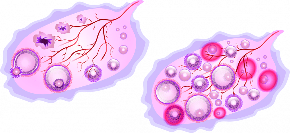 ilustrasi ovarium (pixabay.com/Rosaelemil)