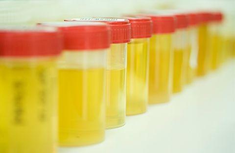 Bukan Dehidrasi, 5 Penyakit Ini Sebabkan Urine Berwarna Cokelat
