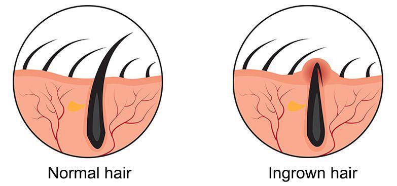 ilustrasi ingrown hair (healthdirect.gov.au)