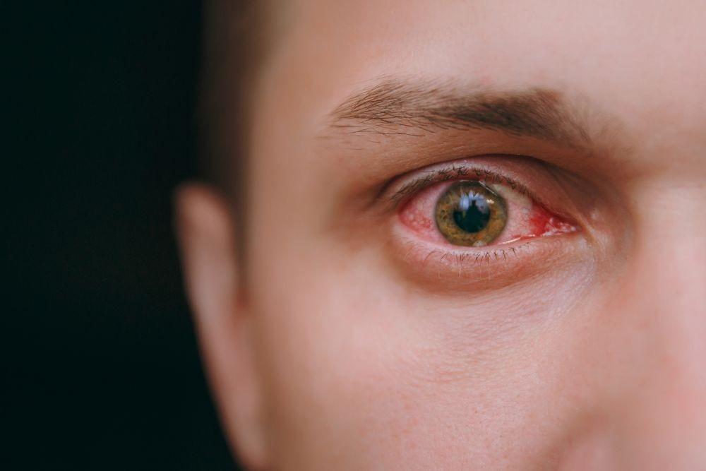 Herpes Mata: Penyebab, Gejala, Diagnosis, Pengobatan
