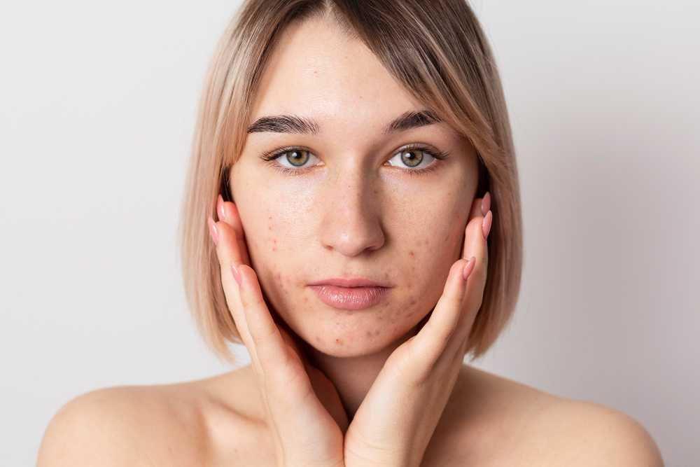 Acne Vulgaris: Penyebab, Gejala, Tips Penanganan, dan Pencegahan