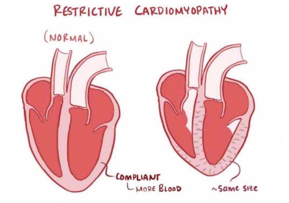 ilustrasi kardiomiopati restriktif (medbooksvn.org)