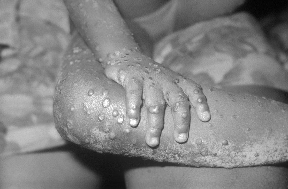 ilustrasi cacar monyet atau monkeypox (commons.wikimedia.org/http://phil.cdc.gov (CDC's Public Health Image Library) Media ID #2329)