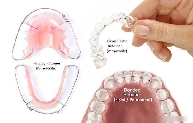 ilustrasi tipe retainer (greatorthosmiles.com)