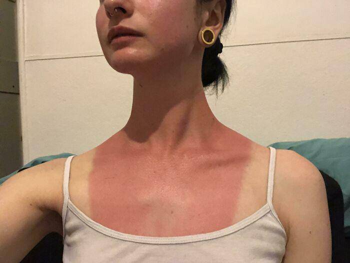 akibat lupa pakai sunscreen (reddit.com/Whitefence227711)
