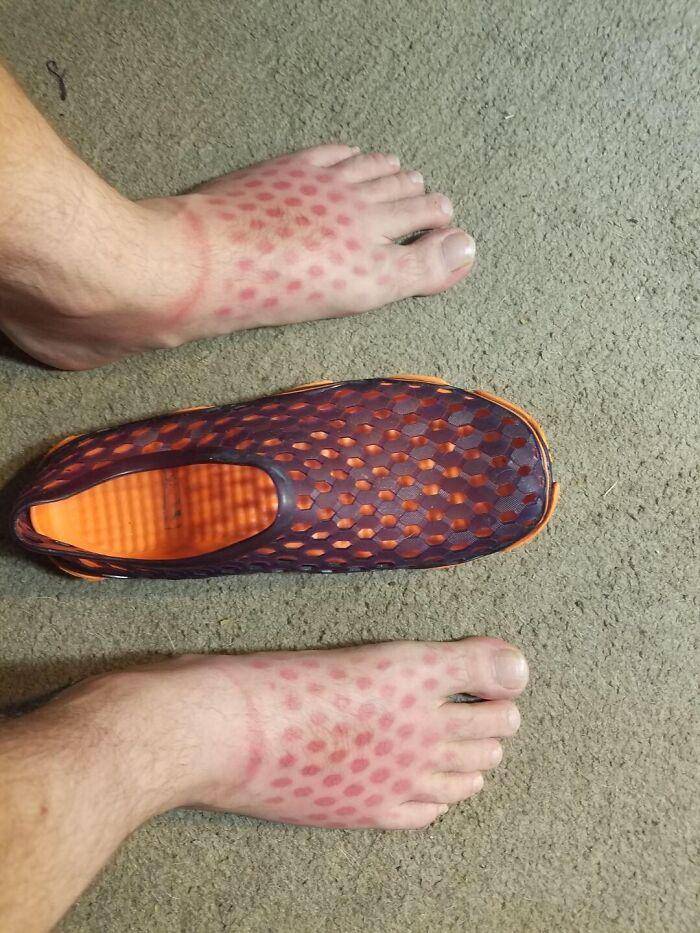 akibat lupa pakai sunscreen (imgur.com/BobHopeLives)