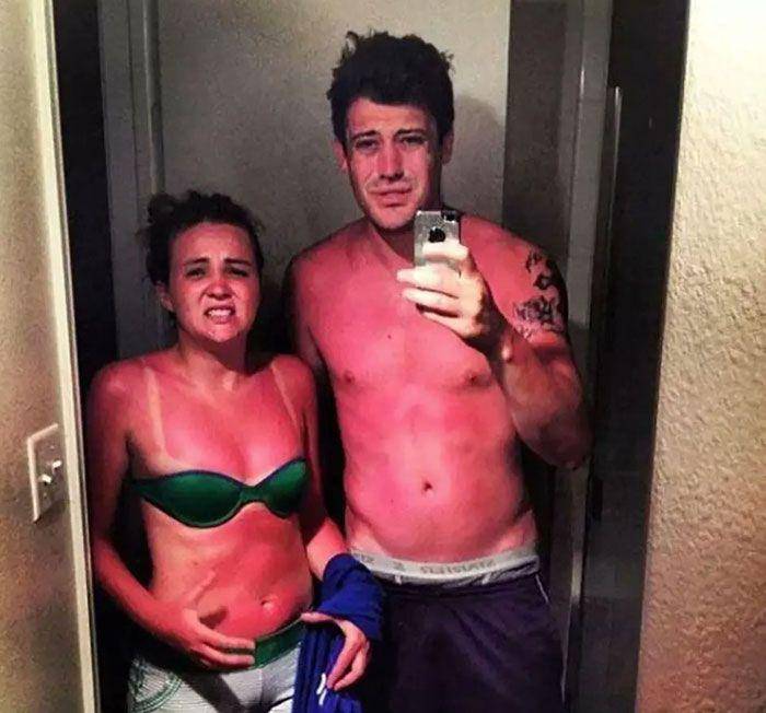 akibat lupa pakai sunscreen (twitter.com/SetCheshire)