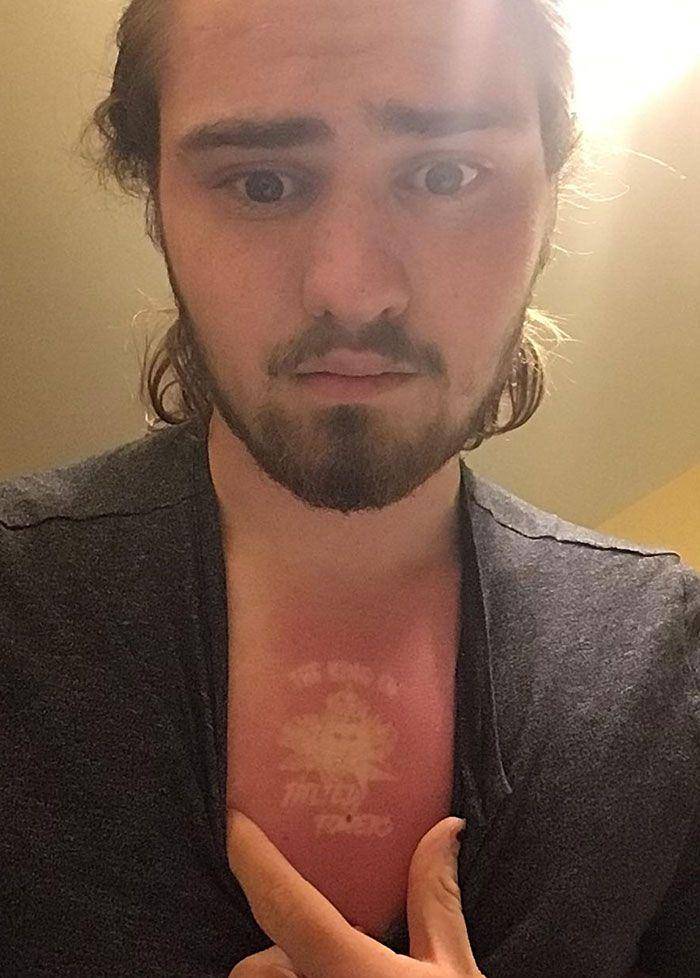 akibat lupa pakai sunscreen (reddit.com/0zzyking)