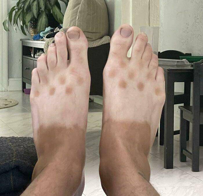 akibat lupa pakai sunscreen (reddit.com/Skintoodeep)