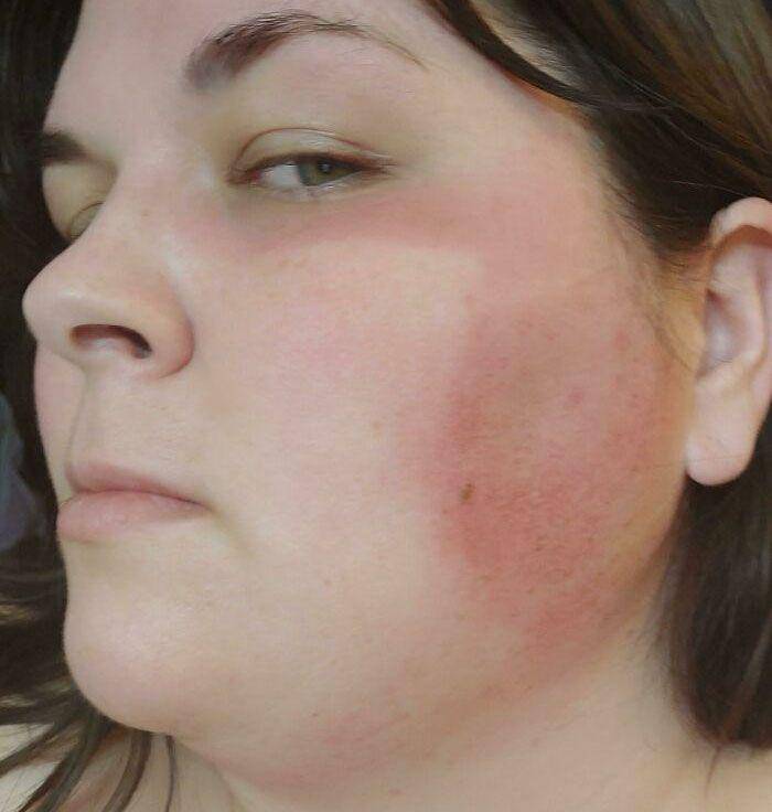 akibat lupa pakai sunscreen (instagram.com/thatwillnotsuffice)
