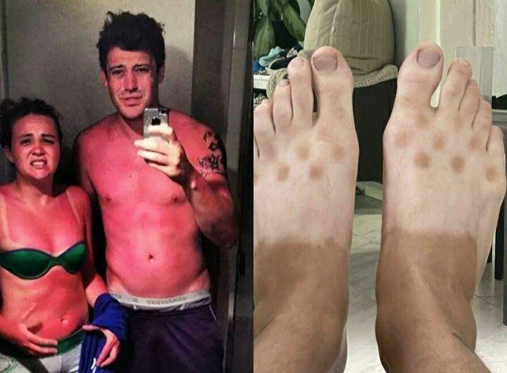 akibat lupa pakai sunscreen (twitter.com/SetCheshire | instagram.com/Skintoodeep)