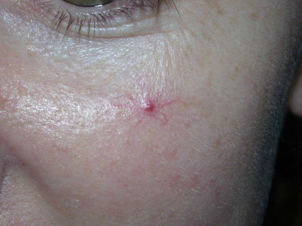 ilustrasi spider angioma (healthjade.net)