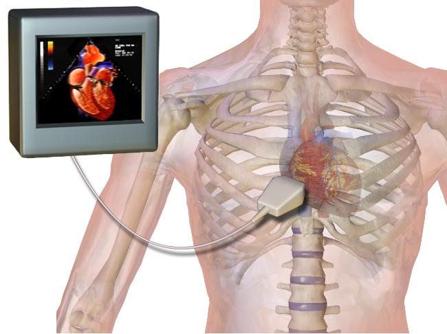 ilustrasi ekokardiogram atau echocardiogram (commons.wikimedia.org/BruceBlaus)