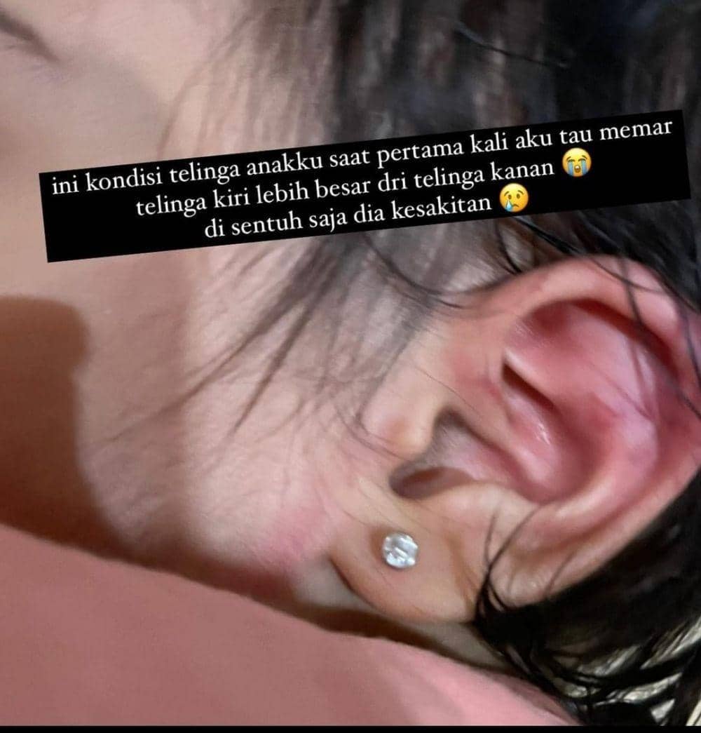 Kondisi telinga balita korban kekerasan. (Instagram @debmanurung)