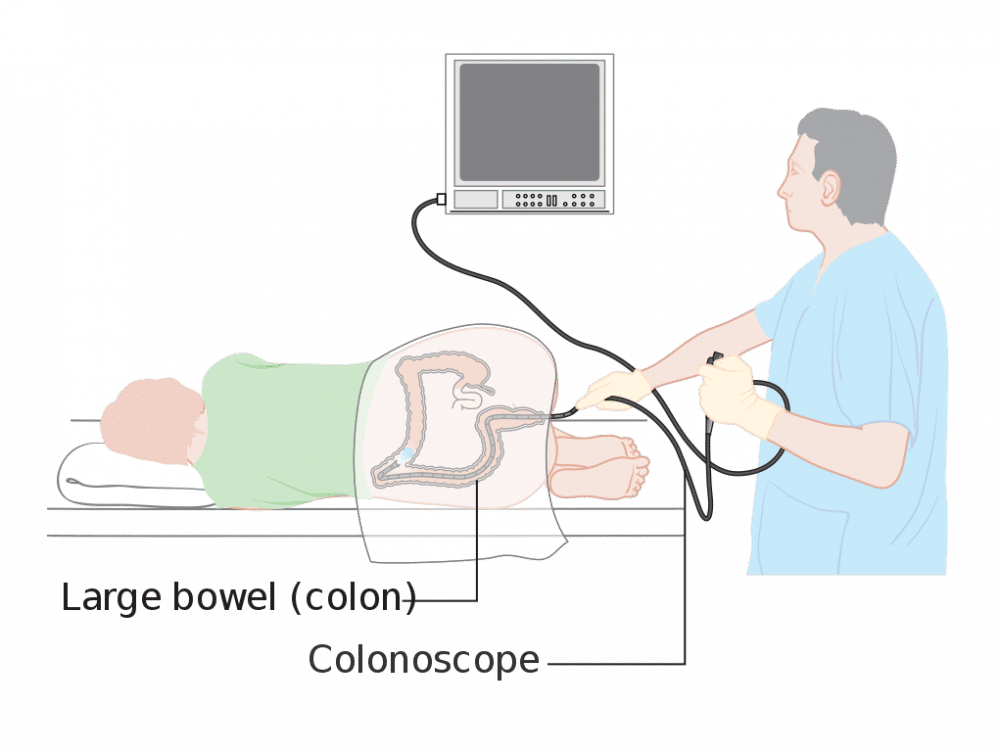 ilustrasi kolonoskopi (commons.wikimedia.org/Cancer Research UK)