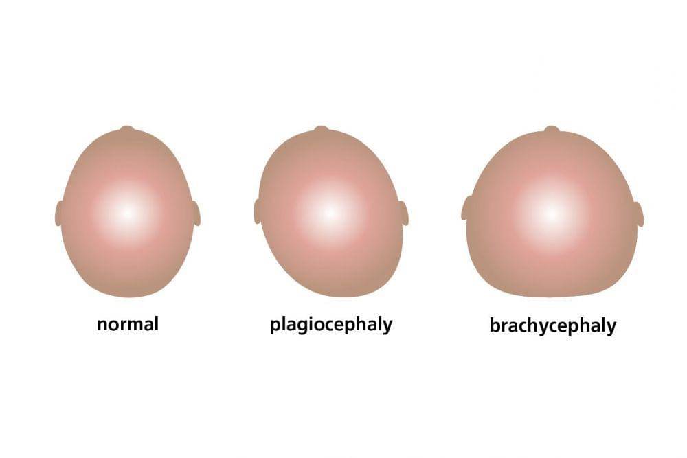 ilustrasi plagiocephaly atau sindrom kepala datar pada bayi (nhs.uk)