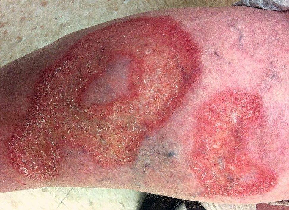 ilustrasi lesi necrobiosis lipoidica (commons.wikimedia.org/Warfieldian)