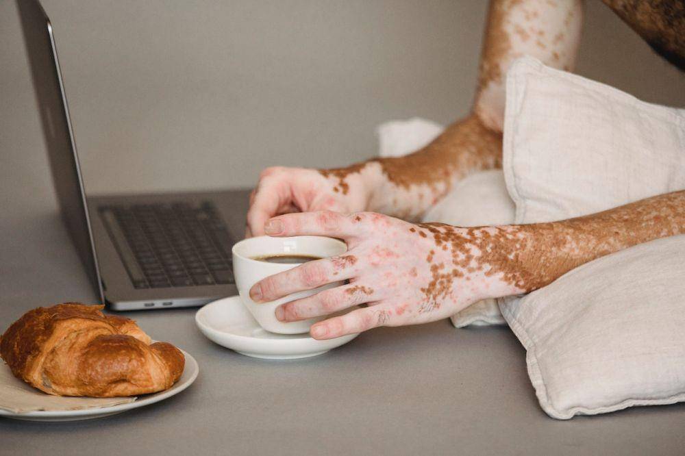 ilustrasi vitiligo, salah satu masalah kulit yang sering menyerang pasien diabetes (pexels.com/Armin Rimoldi)