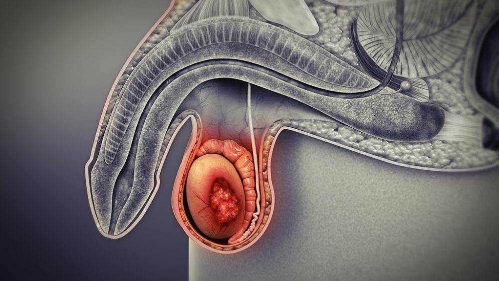 ilustrasi kanker testis (commons.wikimedia.org/www.scientificanimations.com)