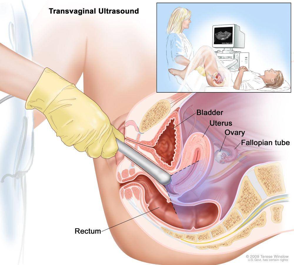 ilustrasi USG transvaginal (cancer.gov)