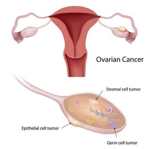 ilustrasi kanker ovarium epitel (immuno-oncologynews.com)