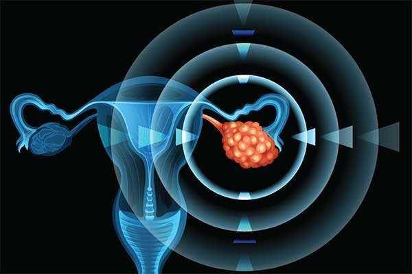 ilustrasi kanker ovarium epitel (medpagetoday.com)