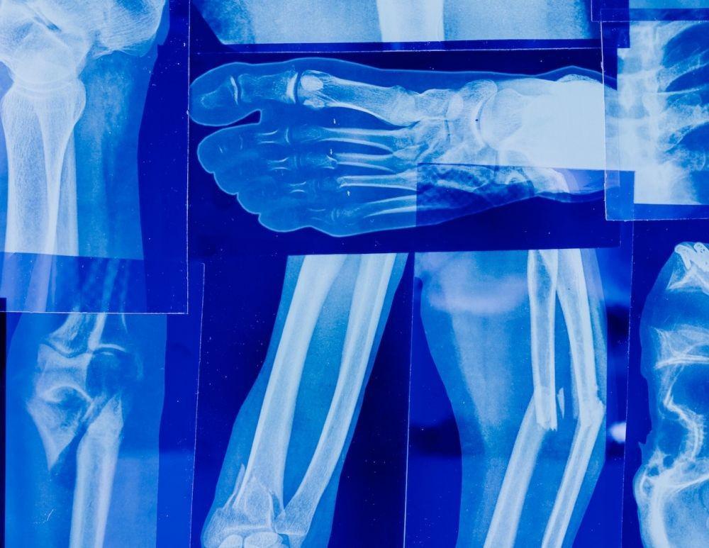 Osteoporosis: Gejala, Penyebab, Diagnosis, Pengobatan