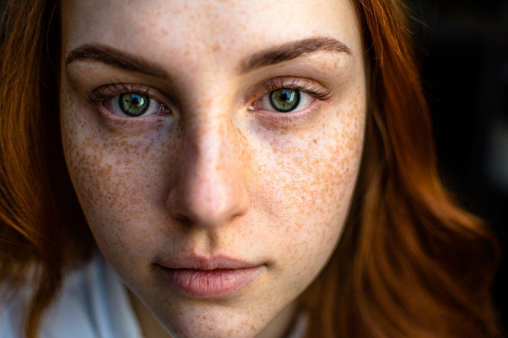 10 Mitos dan Fakta Jerawat, Apakah Muncul Karena Jarang Cuci Muka?
