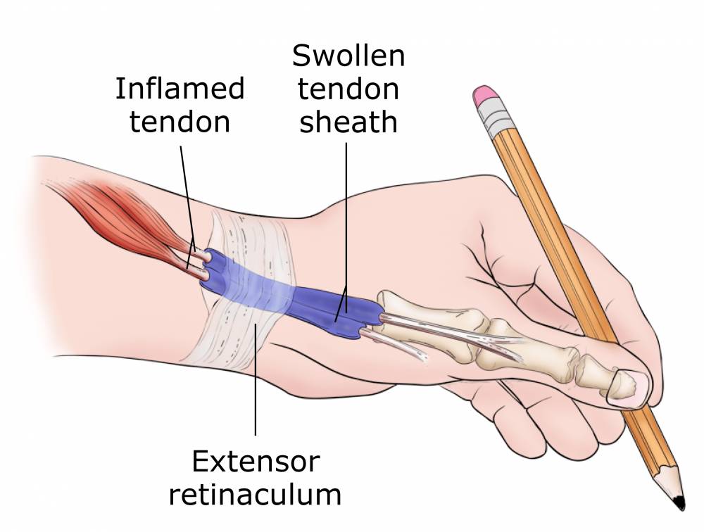 ilustrasi de Quervain syndrome atau de Quervain's tenosynovitis (orthoinfo.aaos.org)