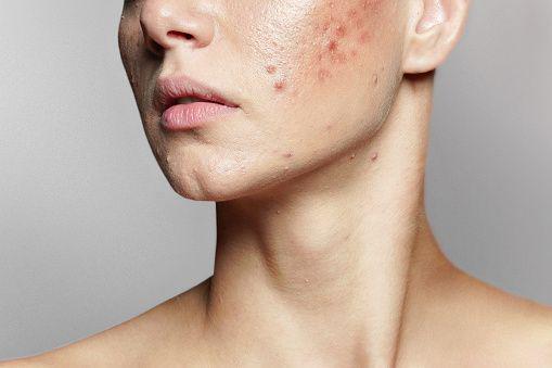 7 Skincare untuk Bantu Hilangkan Bruntusan, Wajib Dicoba!