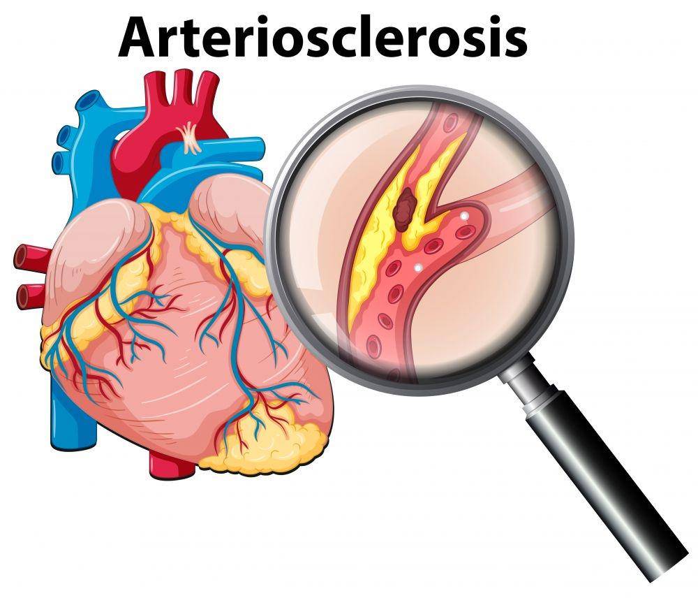 ilustrasi arteriosklerosis (freepik.com/brgfx)