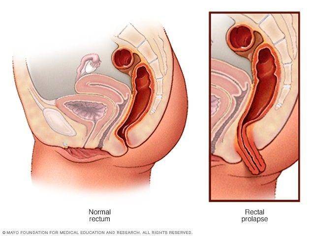 ilustrasi prolaps rektum (mayoclinic.org)