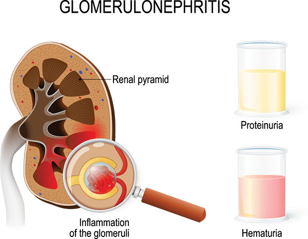 ilustrasi glomerulonefritis (kidney.org)