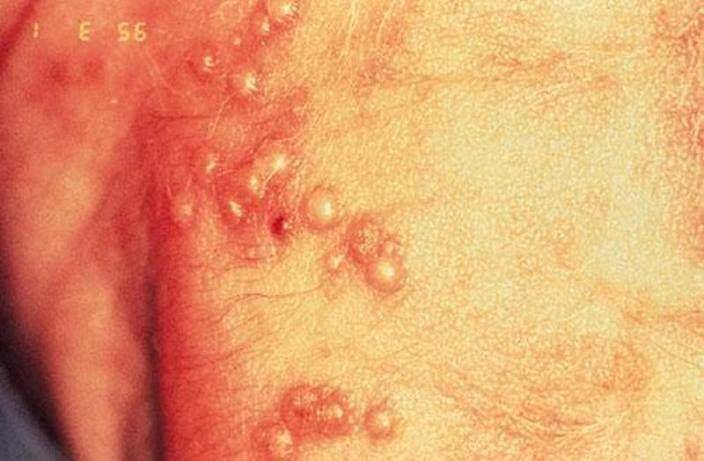 ilustrasi luka atau lepuh pada infeksi virus herpes simpleks (msdmanuals.com/Demmler G: Congenital and perinatal infections. In Atlas of Infectious Diseases: Pediatric Infectious Diseases. Edited by CM Wilfert. Philadelphia, Current Medicine, 1998)