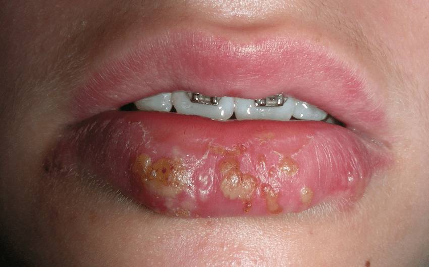 ilustrasi outbreak herpes oral (researchgate.net/Periodontology 2000 80(1):28-48)