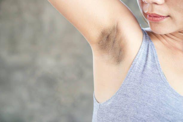 8 Cara Memutihkan Ketiak Hitam dengan Bahan Alami, Mudah!